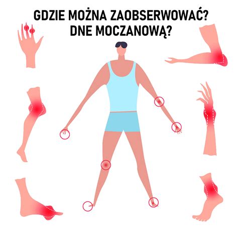 Dna Moczanowa Objawy Przyczyny Leczenie Diagnostyka Choroby Mobile Porn Sex Picture