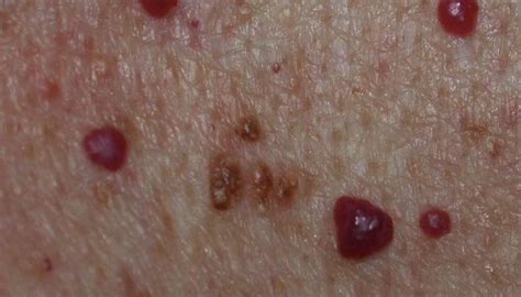 Cherry Angioma Symptoms Causes And Treatment