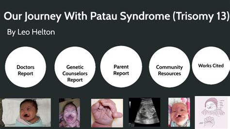 Our Journey With Patau Syndrome By Leo Helton On Prezi