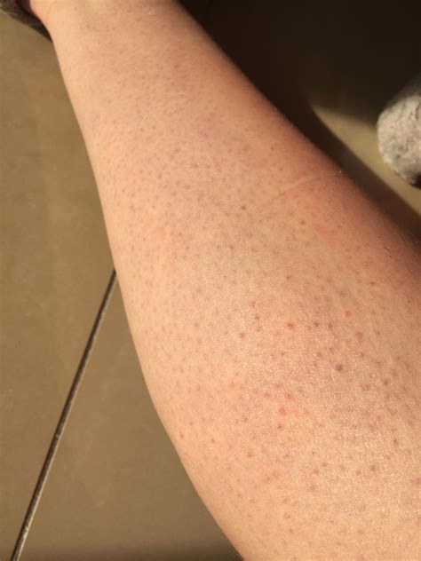 Skin Concerns How Do I Get Rid Of These Bumps On My Legs R Skincareaddiction