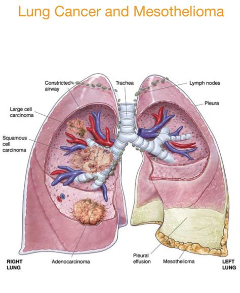 The symptoms of mesothelioma vary depending on where the cancer is located. Mesothelioma information prognosis, symptoms, treatment ...