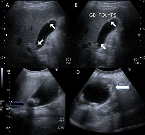 Gallbladder Polyps Ultrasound