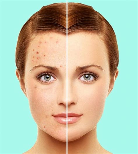 10 Natural Remedies To Manage Rosacea Types Symptoms And Causes