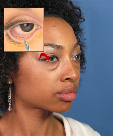 Eyelid Surgery Blepharoplasty San Diego Ca