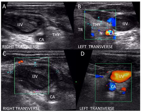 Abnormal Thyroid Cancer Ultrasound Colors Antoine Fry