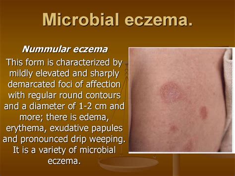 Eczema Dermatitis презентация онлайн