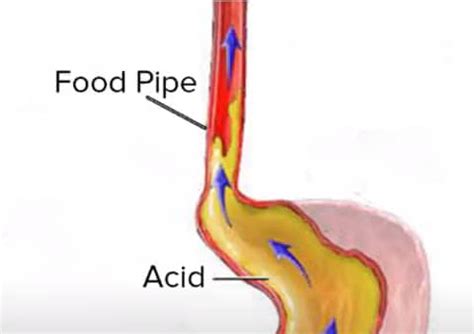 Similarly food and fluids also transits through th a small flap of tissue known as the epiglottis closes the passage to the lungs when food or fluids enter the throat and are swallowed. How to Soothe Acid Reflux - Throat Burn | Health Advisor