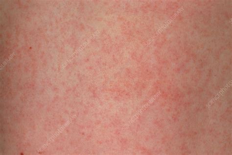 German Measles Rubella Rash On Skin Of A Child Stock Image M210