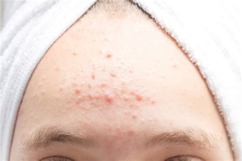 How To Get Rid Of Forehead Acne Forehead Acne Solution