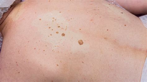 Can Age Spots Be Raised Exploring The Truth Behind Skin Bumps