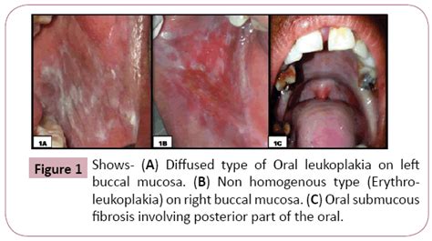 Association Of Candida Species With Oral Submucous Fibrosis And Oral