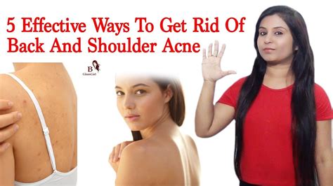 Effective Ways To Get Rid Of Back And Shoulder Acne Effective Home Remedy Bhavya