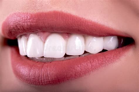 Perfect Healthy Teeth Beautiful Wide Smile Bleaching Procedure