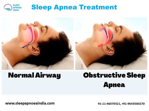 Sleep Apnea Treatment Sc Classifieds