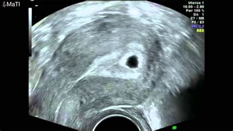 Early Pregnancy Scan Ultrasound 5 Weeks Gestation Youtube