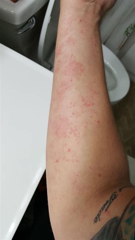 Skin Concerns Ive Had This Eczemarash On Both Arms For