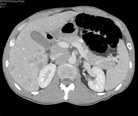 Multiple Liver Abscesses Liver Case Studies Ctisus Ct Scanning