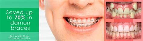 How much does braces cost in arizona. Price/ Cost Braces in Mexico - All Types Price Comparison ...