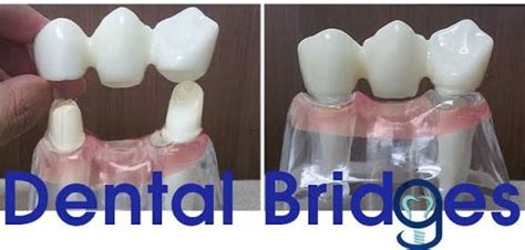 Jenis gigi palsu dental implant merupakan gigi palsu permanen yang dapat berdiri sendiri tanpa bantuan dari gigi lain, ini karena dental implant ditanam ke dalam gusi sehingga gigi mampu berdiri. PRAKTEK DOKTER GIGI AGUS WIYANDONO: MEMILIH GIGI PALSU