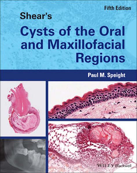 Shears Cysts Of The Oral And Maxillofacial Regions