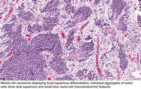 Pathology Outlines Merkel Cell Carcinoma