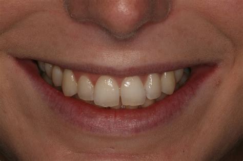 Clinical Tips Smile Line Assessment Irish Dentistry