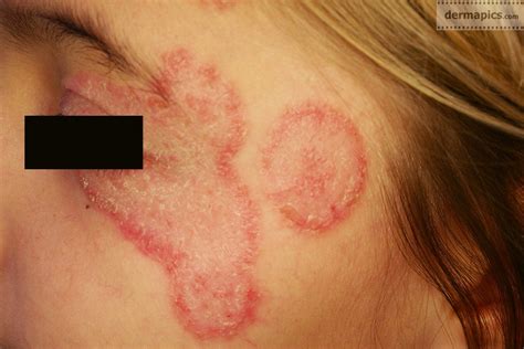 Fungal Infection Of The Skin Ringworm Pictures And Clinical Information