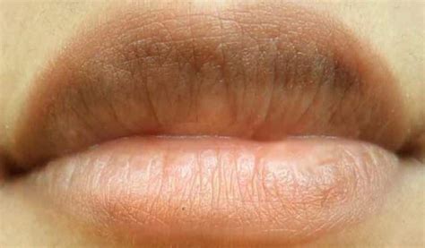 Dark Discoloration On Lips