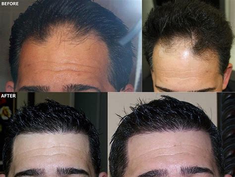 Fue Hairline Hair Restoration Grafts Alviarmani Hair