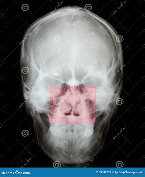 X Ray Of Nasal Bone Fracture Stock Image CartoonDealer 60546733