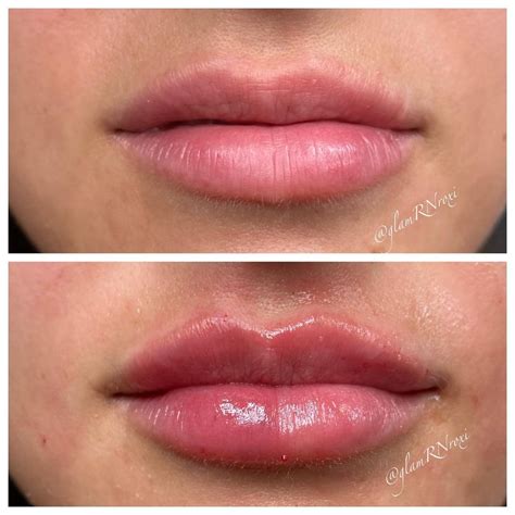 How Much Lip Filler Is Too Much — Glam Aesthetics Lounge