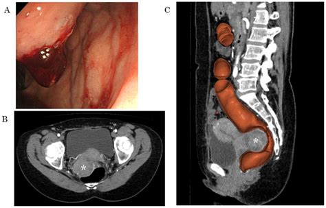 Laparoscopic Posterior Pelvic Exenteration For Primary Adenocarcinoma