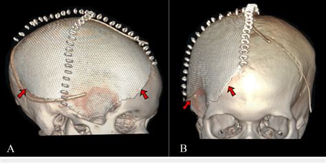 3d Reconstruction Of Post Cranioplasty Computerized Tomography Scans 3d