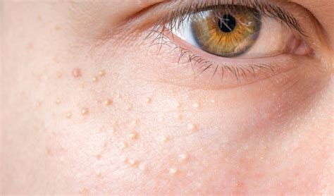 Milia On The Face Causes Prevention And How To Get Rid Of Them Marc