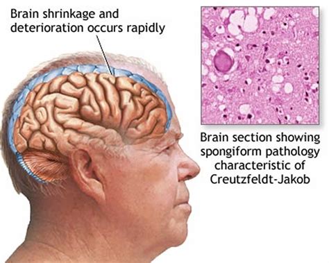 Mad Cow Disease In Humans Zombies