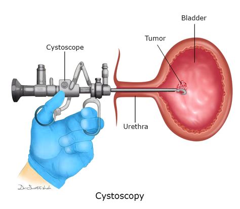 Urinary Bladder Tumour Surgery Is Done For These Symptoms Cancerclinix