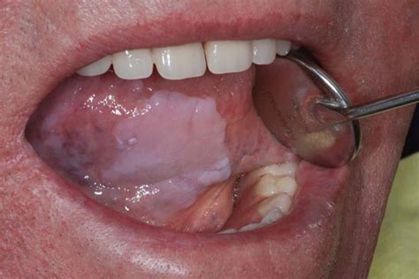 Glycogenic Acanthosis Presenting As Leukoplakia On The Tongue Bmj Case Reports