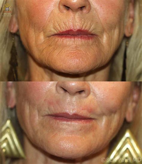 How To Get Rid Of Vertical Lip Lines With Laser