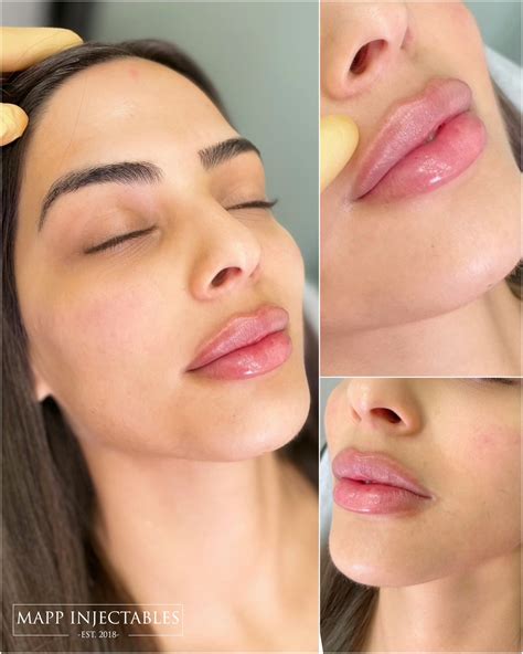 Guide To Finding The Best Clinics For Lip Fillers Near Me