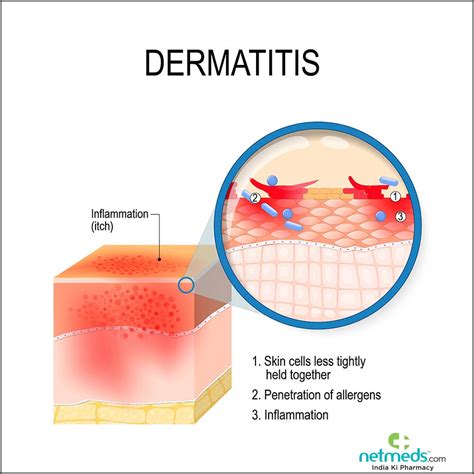 Albums 95 Images Types Of Dermatitis With Pictures Latest 102023