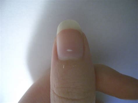 Why Are There White Spots On Fingernails