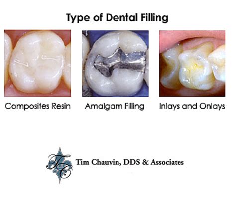 Types Of Fillings Archives Dr Chauvin