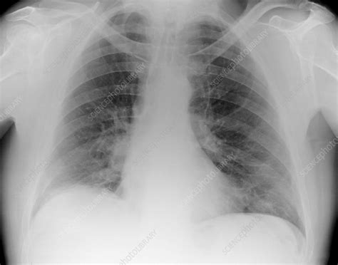 Lung Cancer In Smoker X Ray Stock Image C0111784 Science Photo