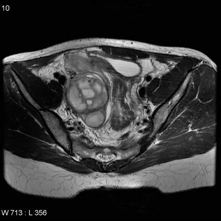 Tubo Ovarian Abscess Radiology Reference Article Radiopaedia Org