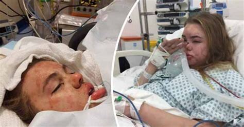 ‘this Is What Ecstasy Does Mum Posts Pics Of Teen In Coma After Taking Party Drug Daily Star