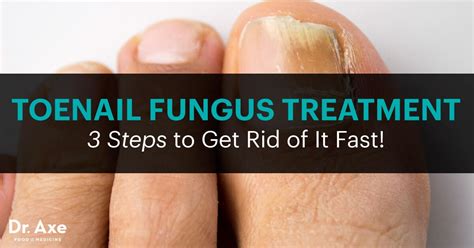 Toenail Fungus Treatment 3 Steps To Get Rid Of It Fast Dr Axe