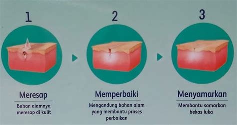 Penanganan Luka Bakar Yang Tepat Pada Si Kecil Dekcrayon Tata