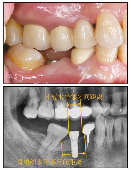 Uprighting A Mesially Tilted Mandibular Second Molar By Using A Dental