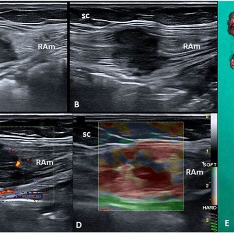 Long A And Short B Axis B Mode Ultrasound Us Images Show The
