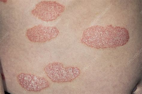 Plaque Psoriasis On The Back Stock Image C0117479 Science Photo
